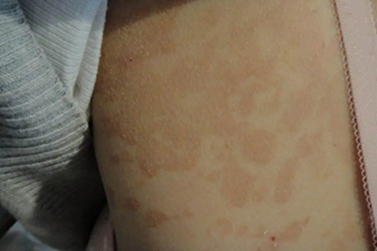 花斑癣背部症状图