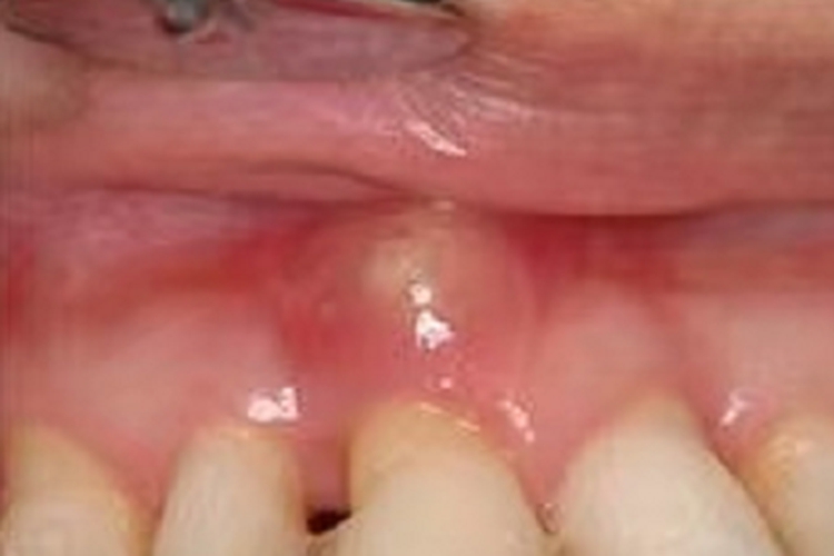 根尖周炎脓包图