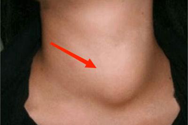 甲状腺腺瘤前颈硬包图 甲状腺腺瘤前颈硬包图