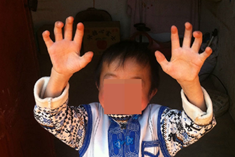 黏多糖贮积症Ⅲ型症状图 黏多糖贮积症Ⅲ型症状图