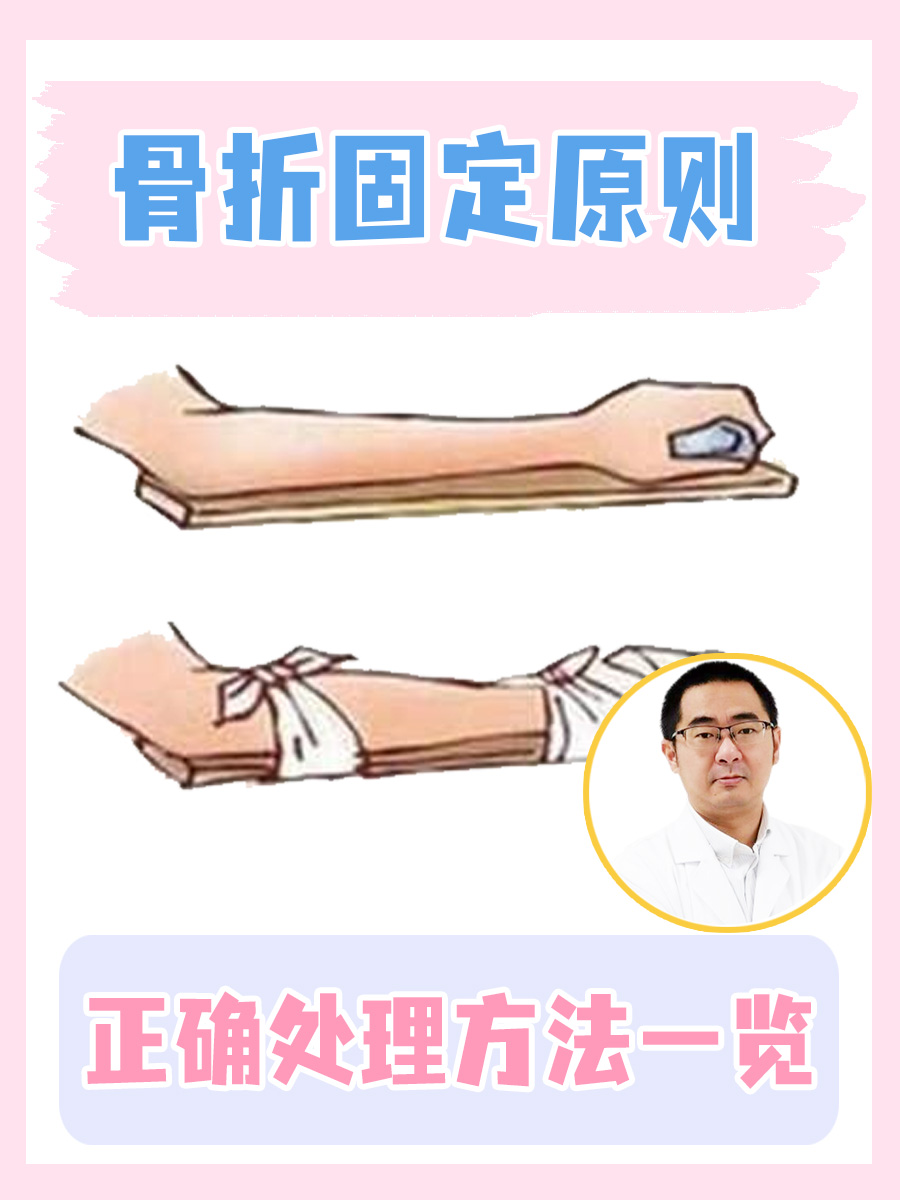 骨折固定原则，正确处理方法一览