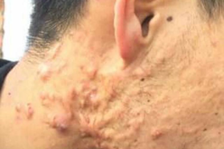 寻常痤疮侧颈瘢痕图