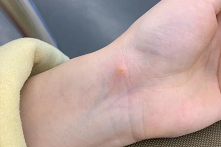 跳蚤叮咬手腕小红疙瘩图 跳蚤叮咬手腕小红疙瘩图