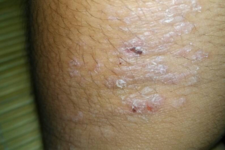 柯萨奇湿疹胳膊脱屑结痂图