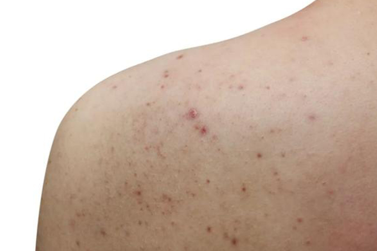 背部痤疮图 背部痤疮图