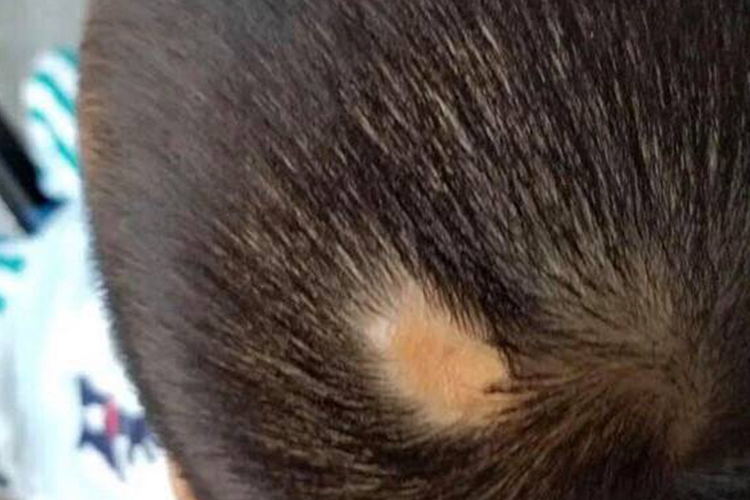 斑秃头顶有椭圆形脱发区图