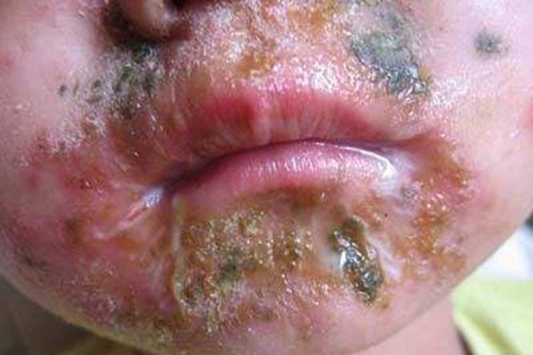 深脓疱疮口周糜烂渗液图