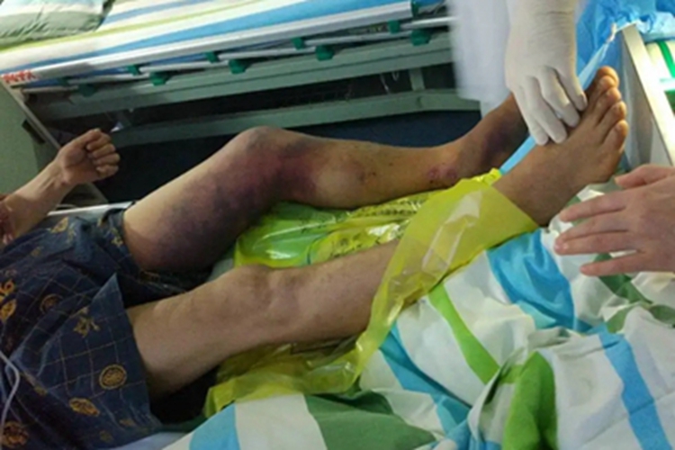 毒蛇咬伤大腿症状图 毒蛇咬伤大腿症状图