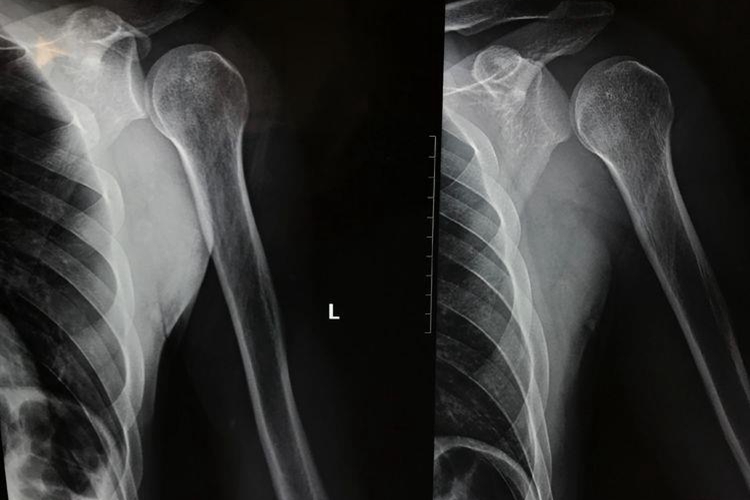 肩关节后脱位X线图 肩关节后脱位X线图