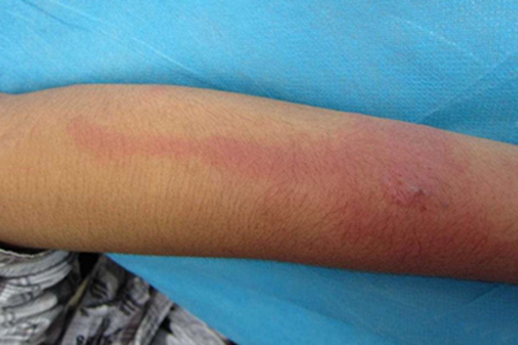 急性管状淋巴管炎胳膊红肿图