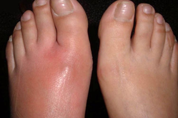 皮肤丝虫病脚背症状图