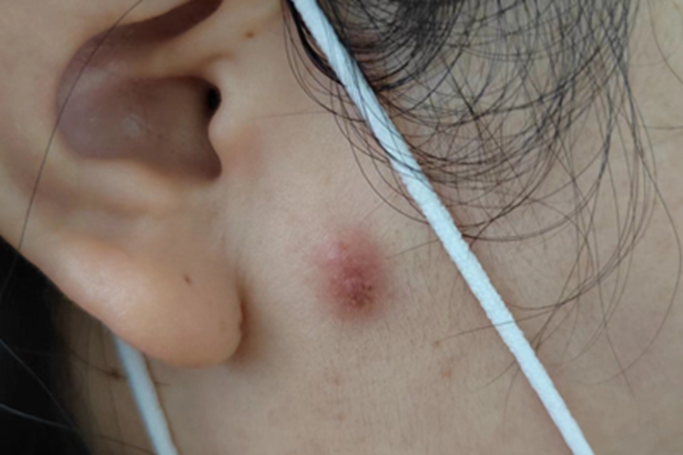 表皮样囊肿皮肤有囊肿图