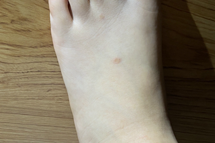 扁平疣脚部症状图