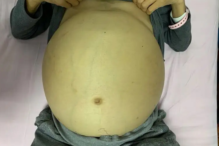 肝病全腹腹胀图