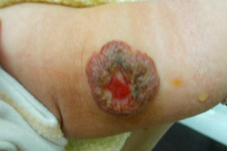 小儿血管瘤胳膊破溃结痂图