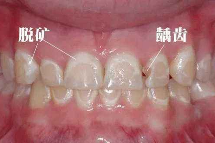 牙齿脱矿图