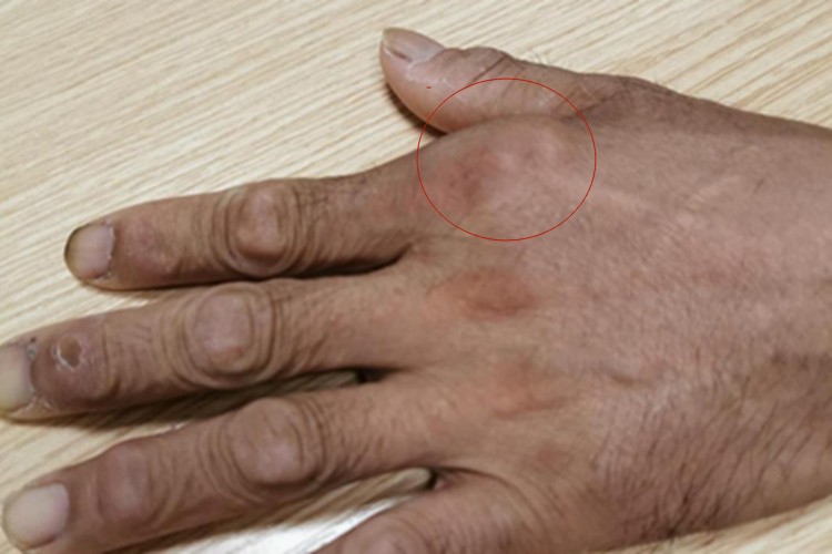 痛风性关节炎手指硬疙瘩图 痛风性关节炎手指硬疙瘩图