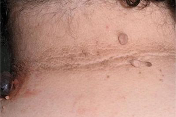 软纤维瘤后颈疙瘩图 软纤维瘤后颈疙瘩图