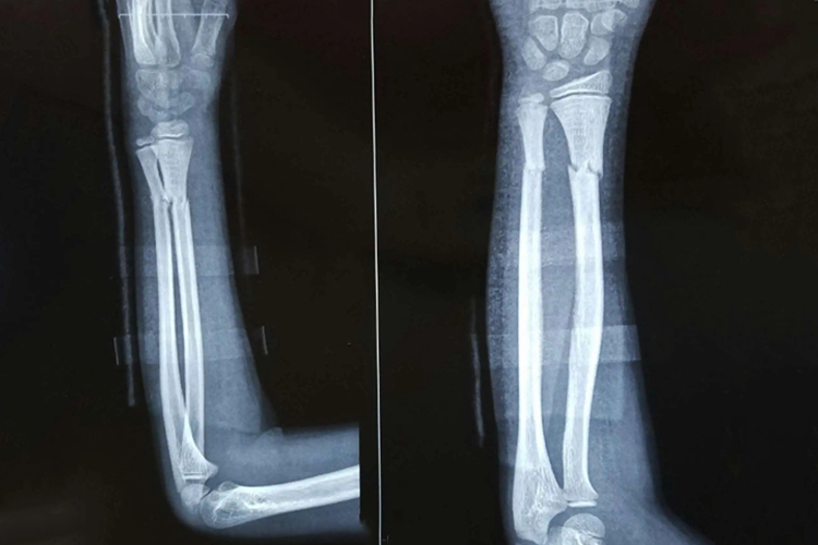 右尺桡骨骨折X线片图