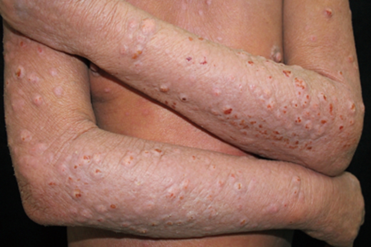 结节性痒疹硬疙瘩图