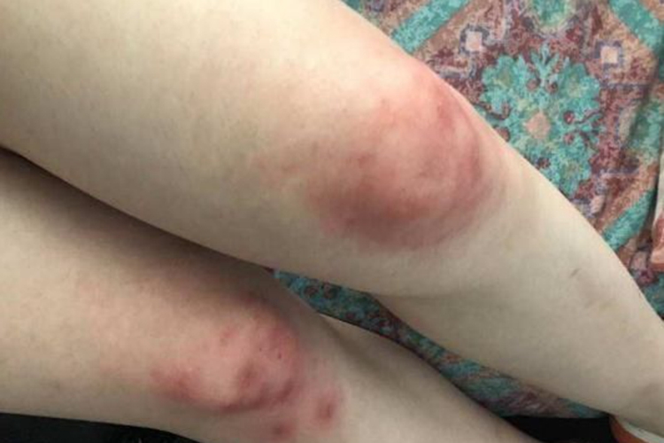 念珠状链杆菌型鼠咬热膝盖红肿图