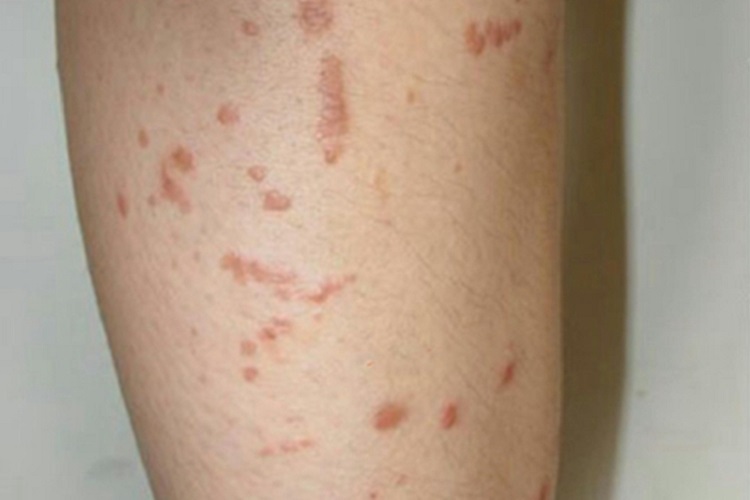 职业性疣赘小腿症状图 职业性疣赘小腿症状图