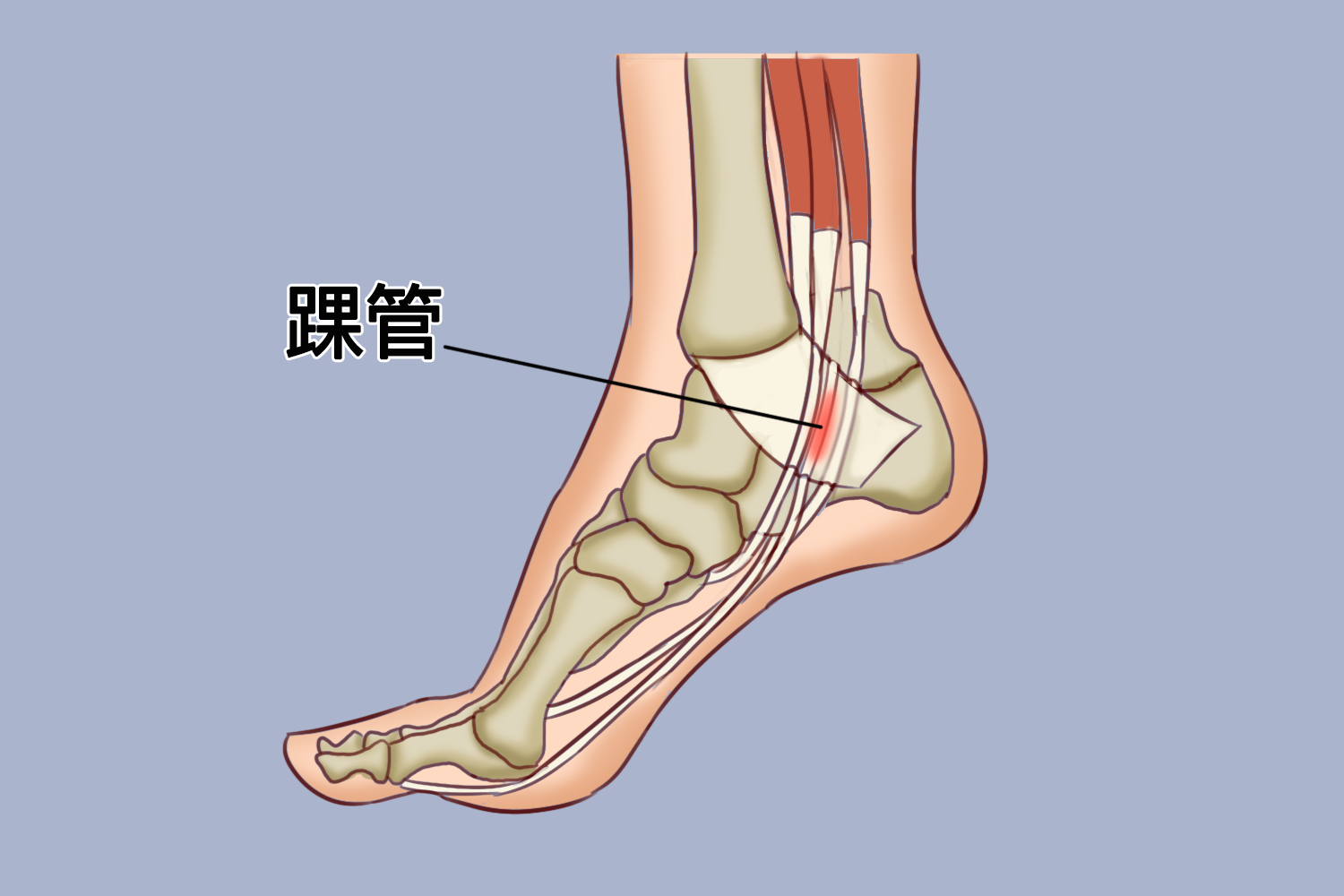 刺痛感,多分布于内踝后方踝管局部,可沿内侧纵弓向足底放射,部分患者