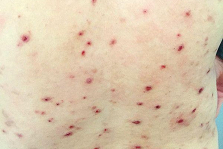 丘疹坏死性结核疹长丘疹图