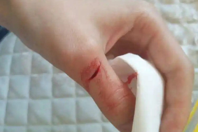 手指被刀割出血图