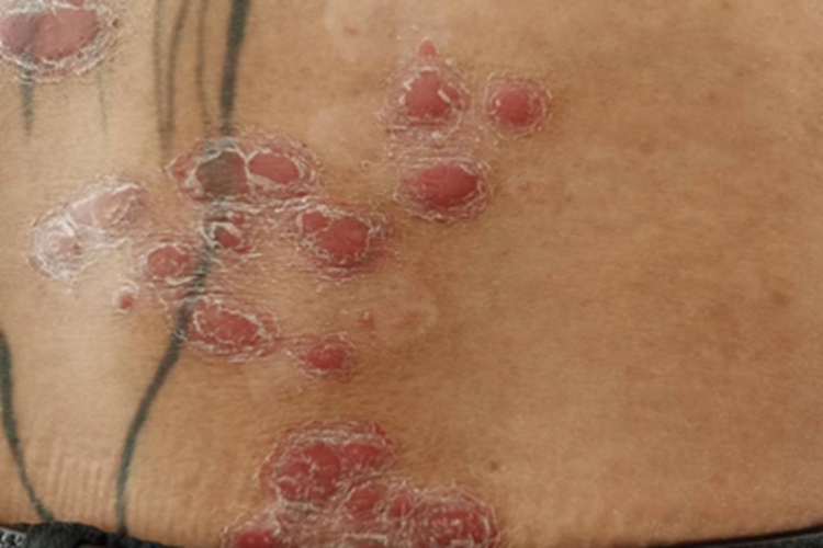 银屑病腰部症状图