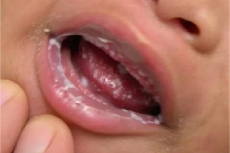 小儿口炎嘴唇白斑图