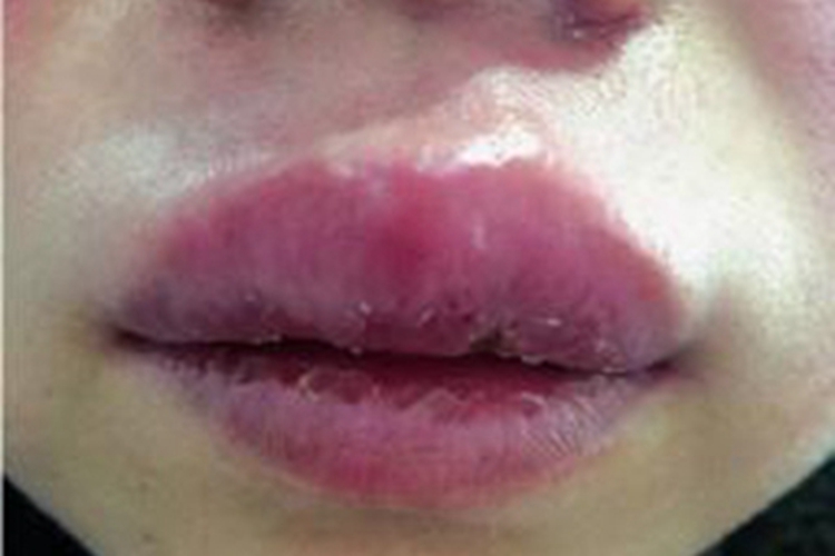 肉芽肿性唇炎嘴唇脱屑图 肉芽肿性唇炎嘴唇脱屑图