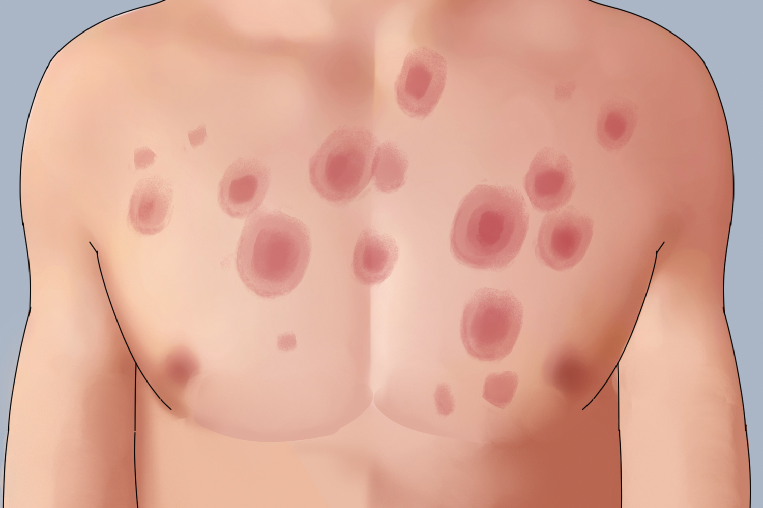 胸部多形红斑图