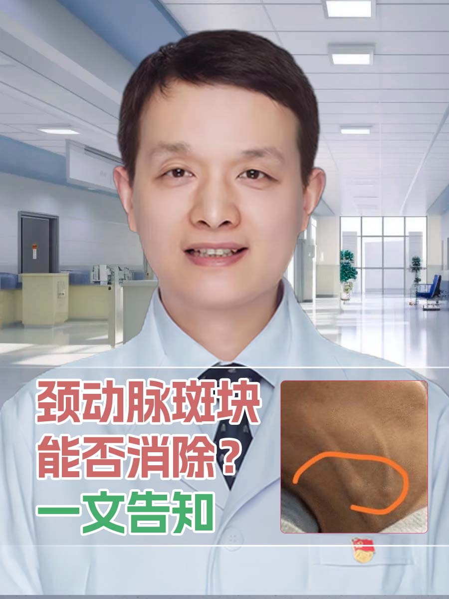 颈动脉斑块能否消除？一文告知