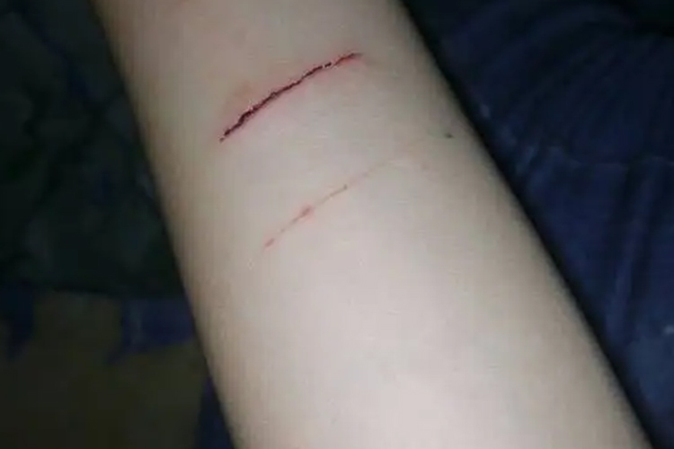 手臂切割伤