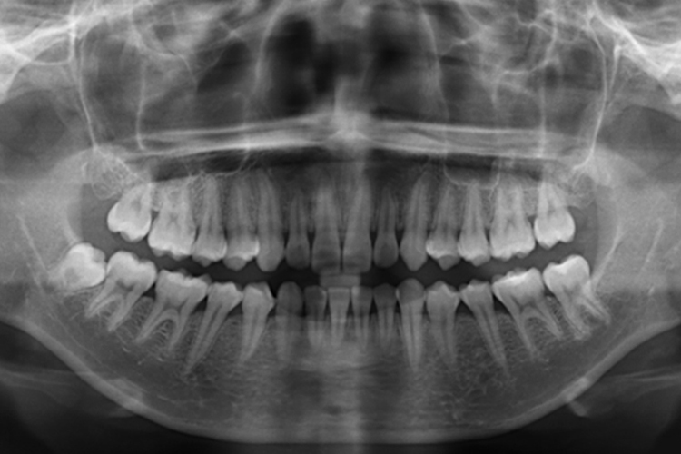 正常牙齿拍片图