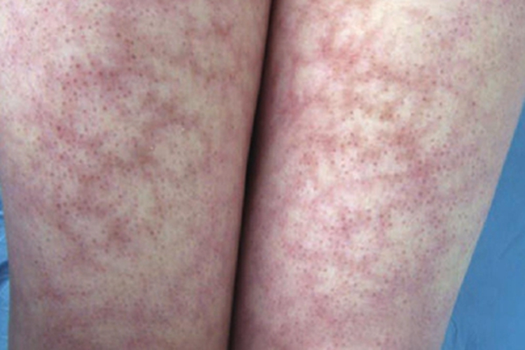 马歇尔-怀特综合征大腿长白斑图