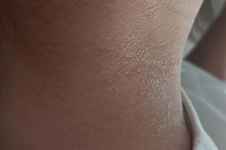 日光性皮炎前颈小疙瘩图