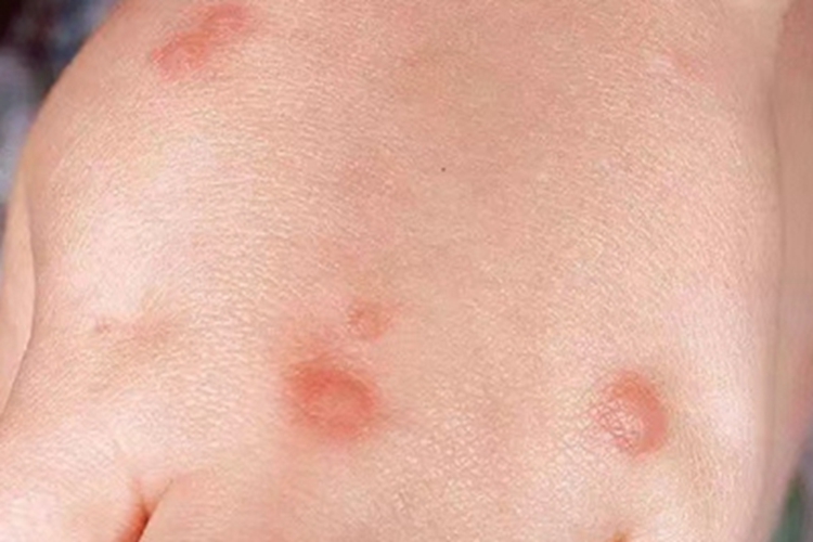 单纯性痒疹手背有水疱样红疙瘩图