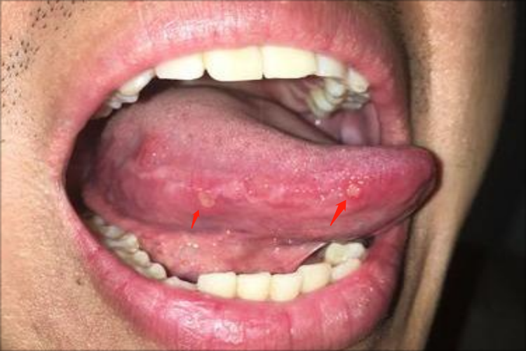 疱疹样阿弗他溃疡舌侧溃疡图