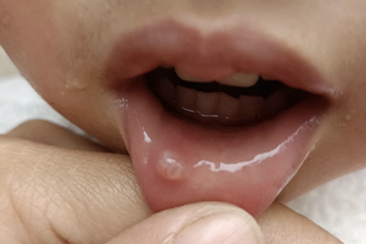 黏液腺囊肿水疱图