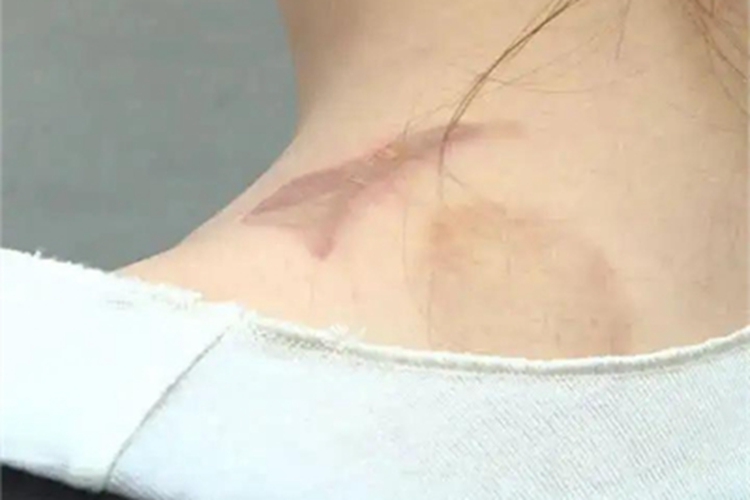 一度烫伤脖子发红图