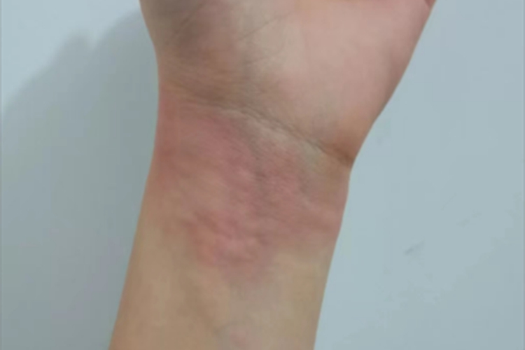 荨麻疹手腕风团图
