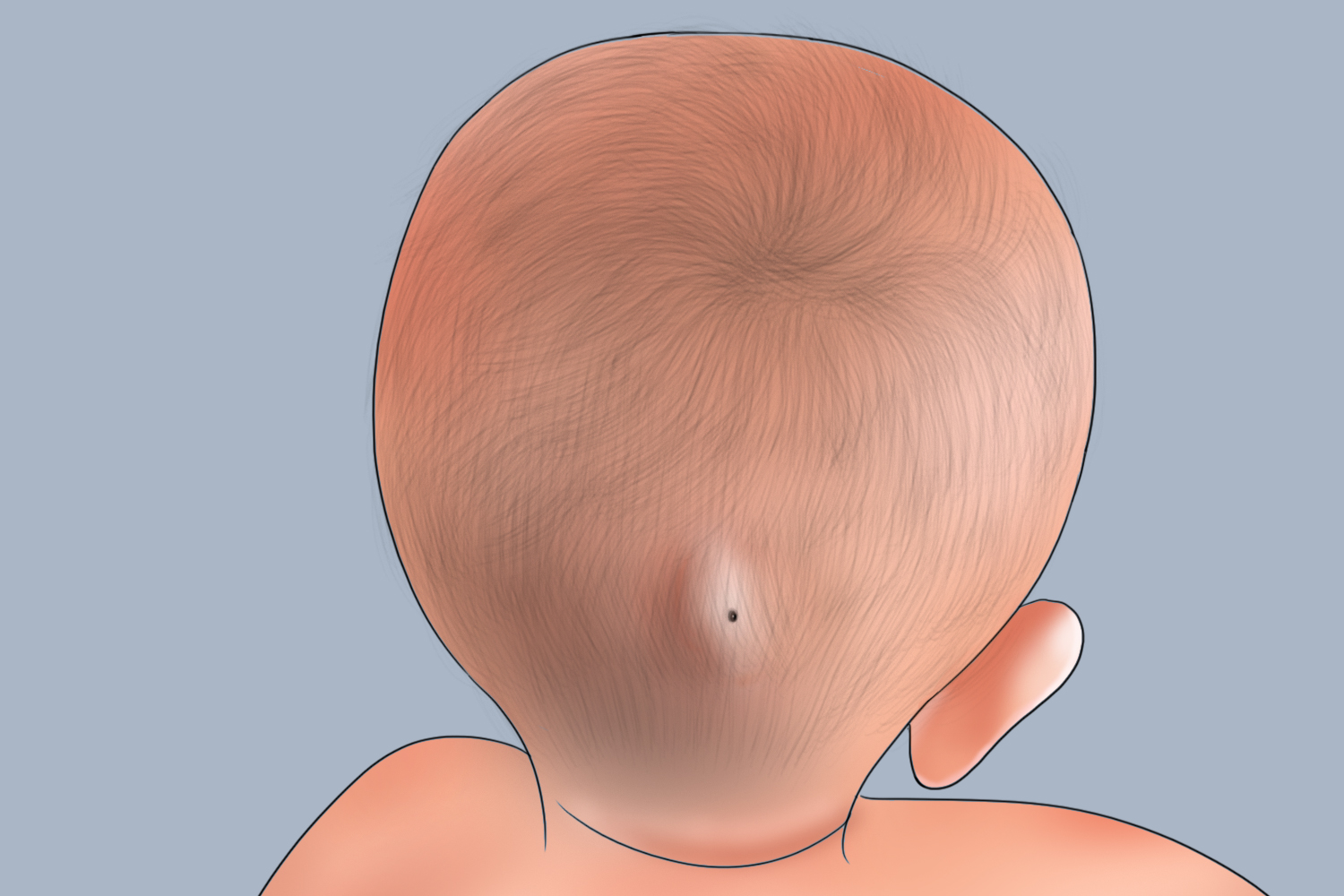 后脑勺长粉瘤图
