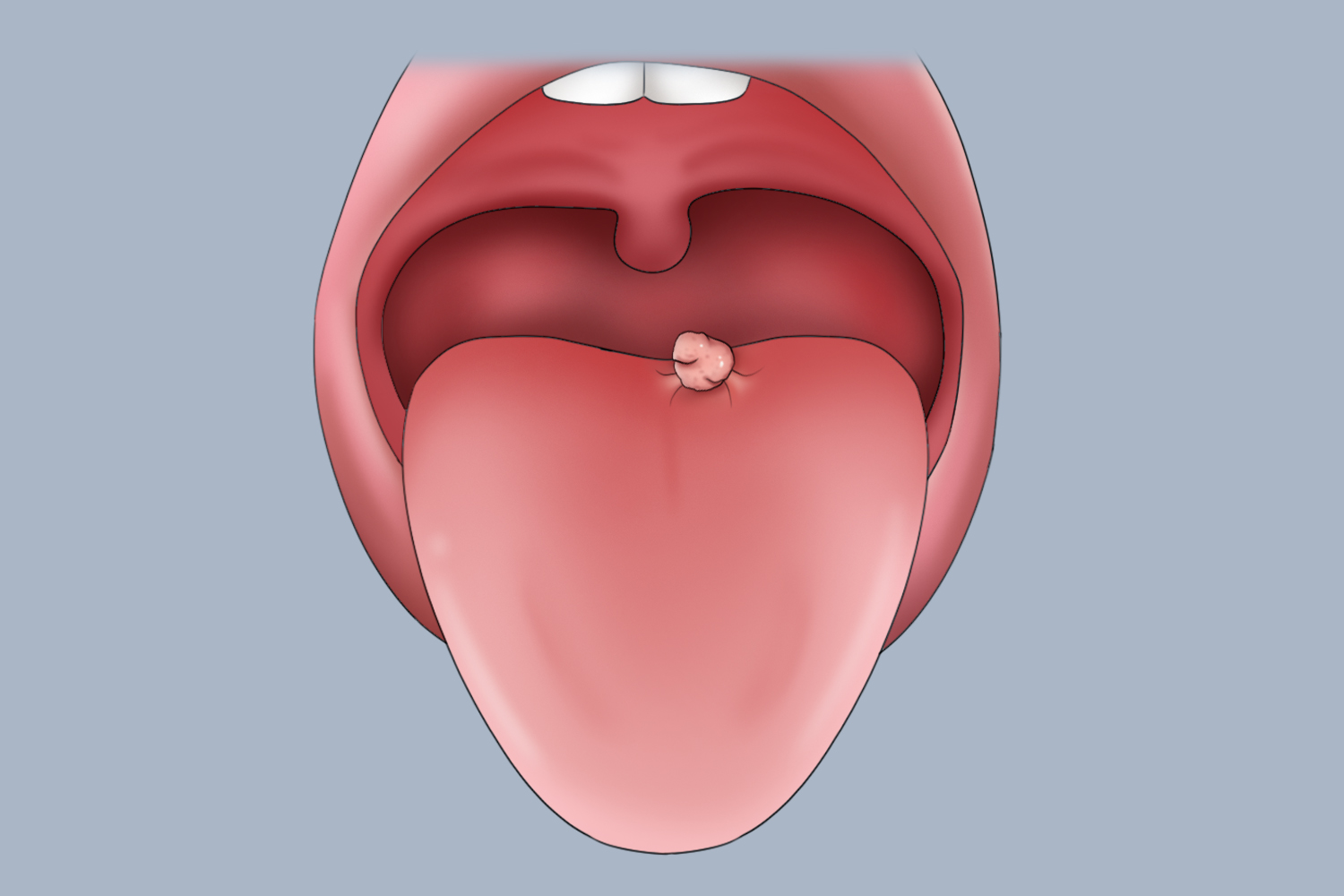 舌根疣体图片图片