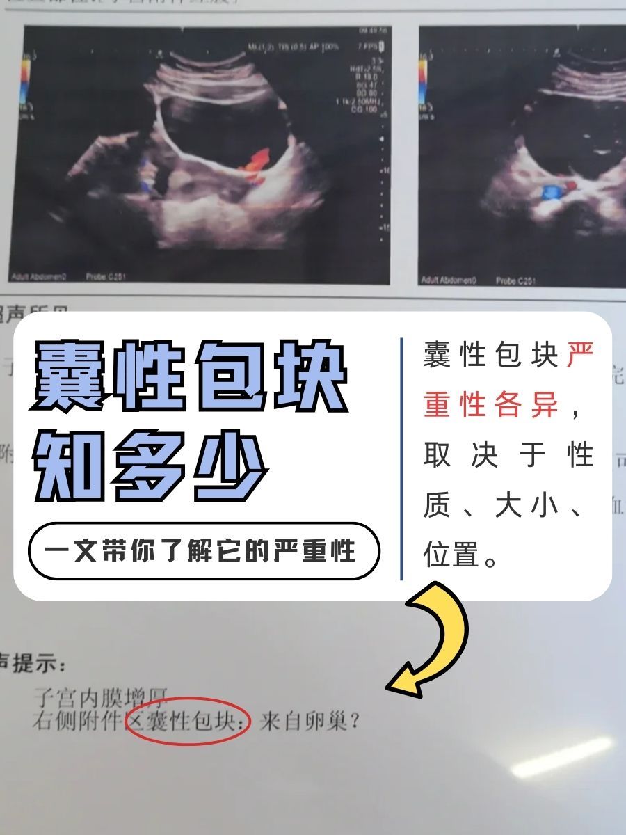 囊性包块知多少？一文带你了解它的严重性