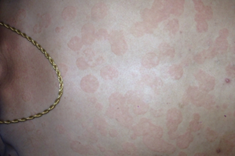 花斑癣胸前长片状斑图 花斑癣胸前长片状斑图