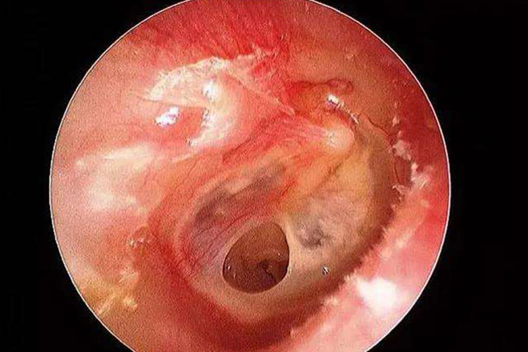 急性化脓性中耳炎图