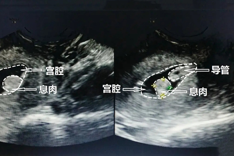 子宫内膜息肉图 子宫内膜息肉图