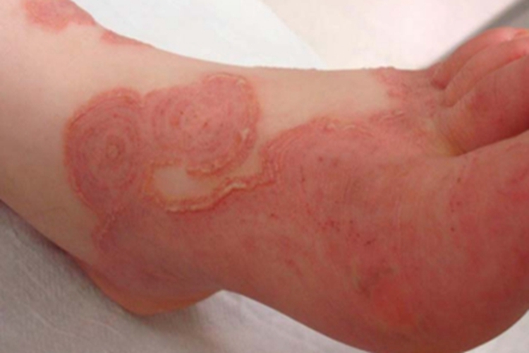 寻常狼疮脚背红斑图